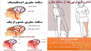 تداوی فزیوتراپی بعد از سکته مغزی کلینک فزیوتراپی اقبال سرک اول کارته نو کابل
